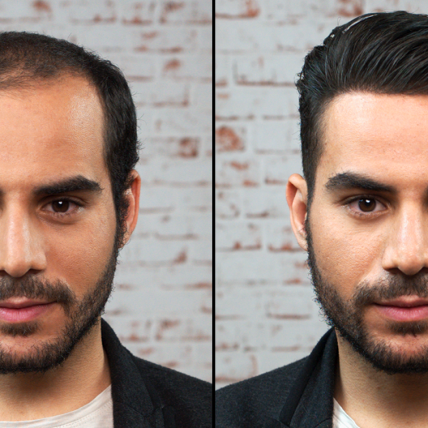 permenant-hair-replacement-solution